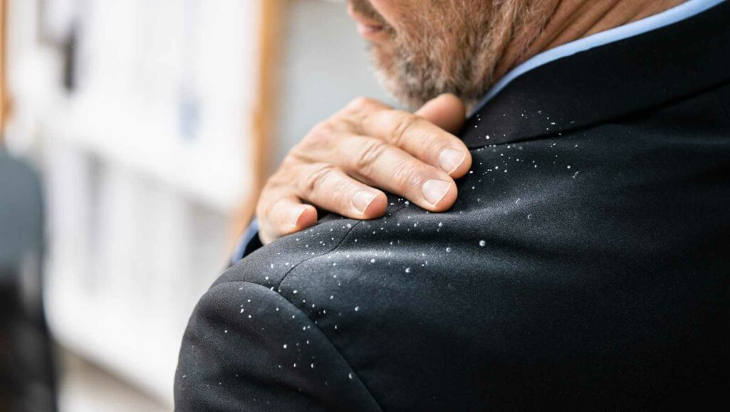 Man Dandruff On Suit Shoulder. Dirty Clothes