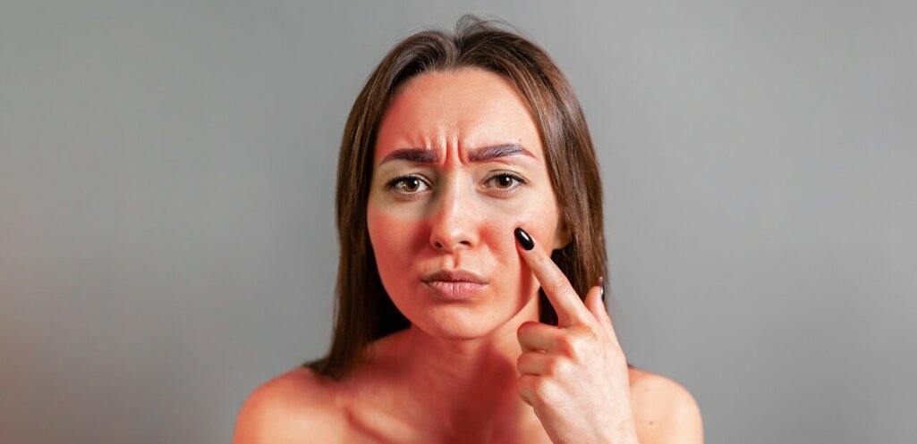 woman points a finger at a face reddened by sunburn