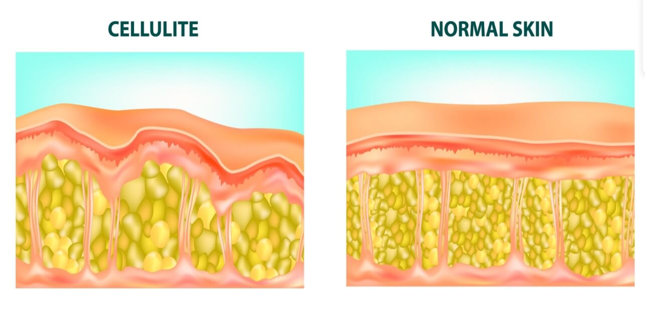 Illustration of skin cross section of Cellulite formation. Vector diagram.