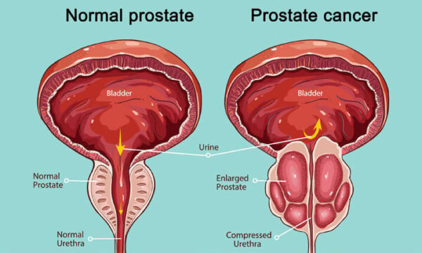 prostatic cancer