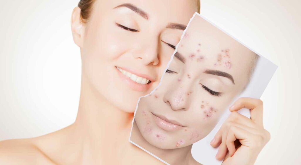 closeup portrait of woman with clean skin holding portrait with pimpled skin