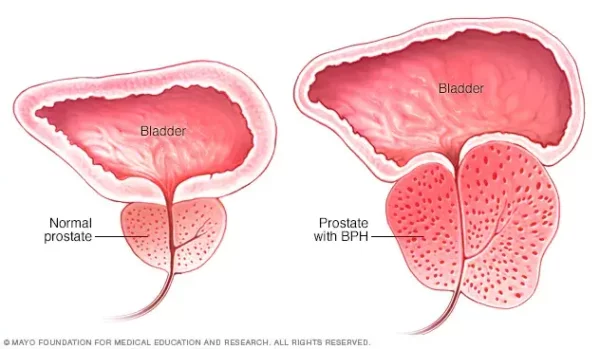 prostatic hyperplasia