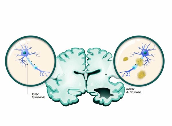 υγιής εγκέφαλος vs νόσος αλτσχάιμερ