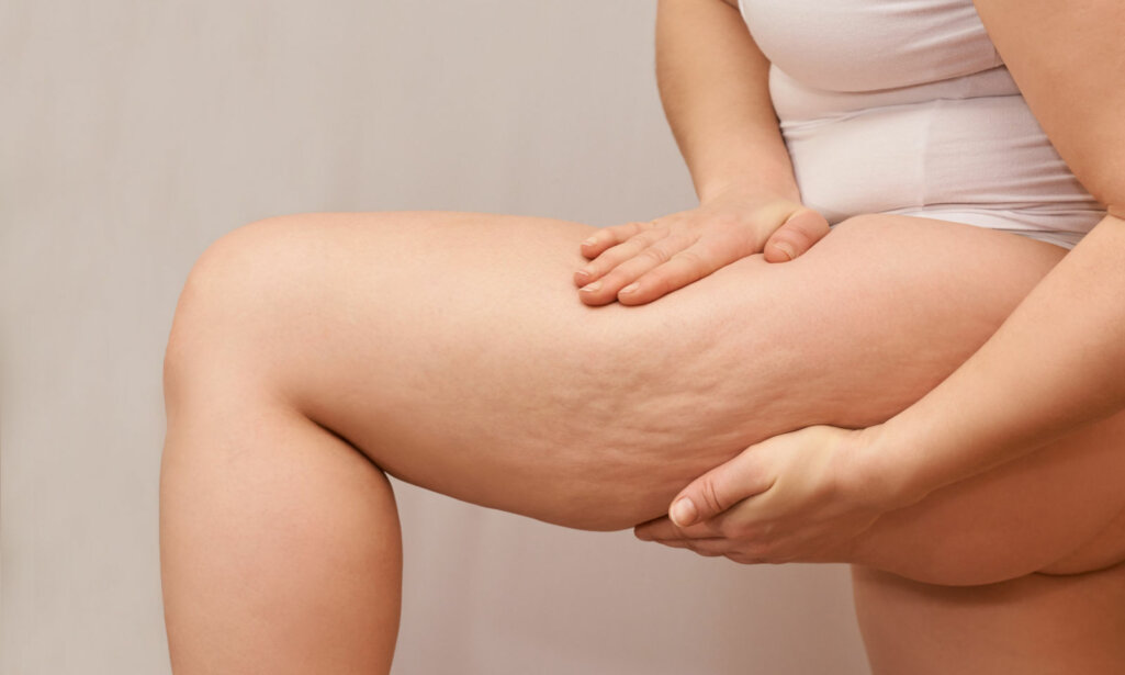 Cellulite leg at pregnant woman