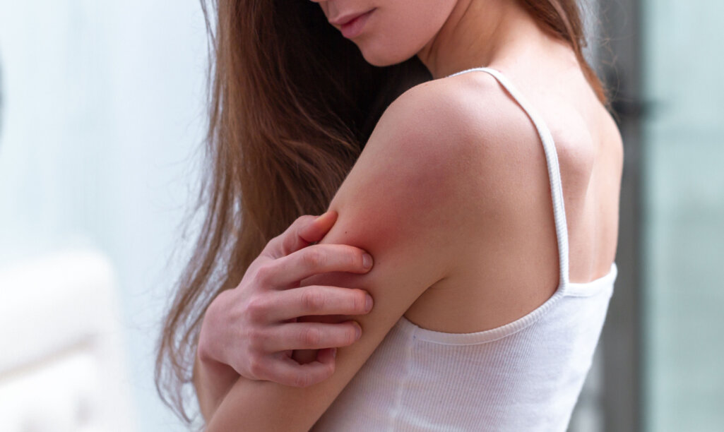 Δερματικές αλλεργίες: Αίτια, συμπτώματα & αντιμετώπιση