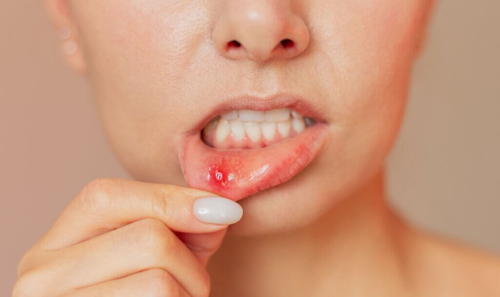 Γυναίκα κατεβάζει το κάτω χείλος της, το οποίο έχει πληγή-άφθα και έχει ερεθιστεί